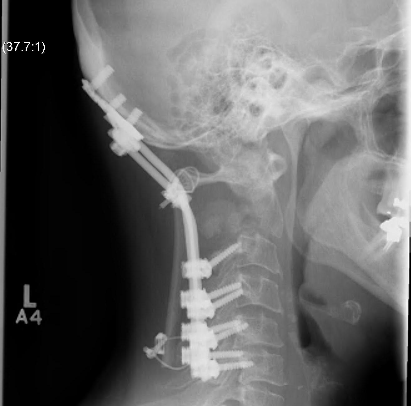 Cervical Tumour Posterior Stabilisation